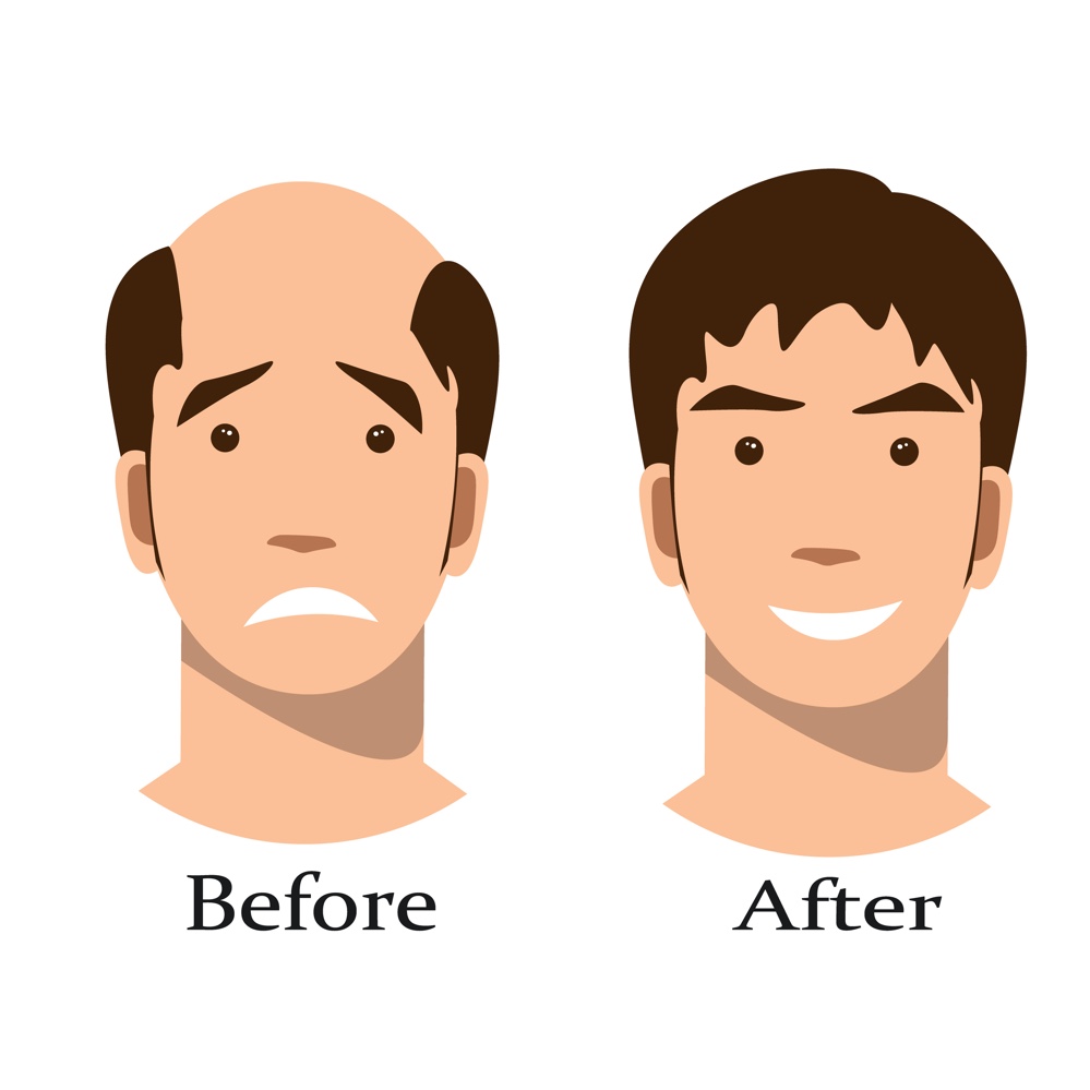 Before After Man Illustration Toupee