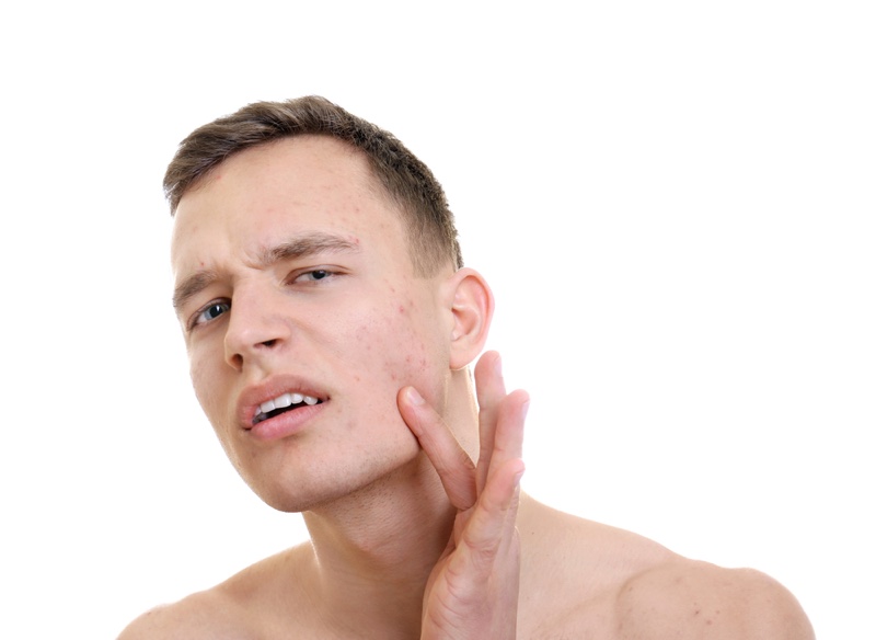 Young Man Acne Breakout Skin Problem