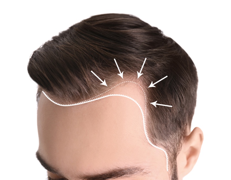 Man Hairline Hair Loss Man Hairline Hair Loss