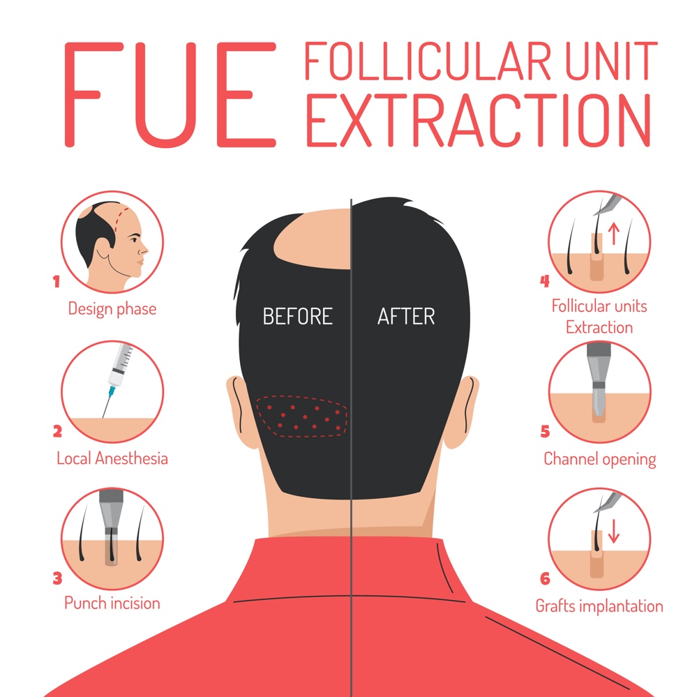 FUE Method Hair Transplant