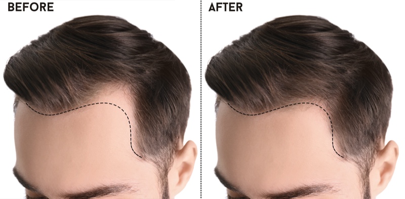 Common Myths & Misconceptions About Hair Transplants – The Fashionisto Common Myths & Misconceptions About Hair Transplants – The Fashionisto