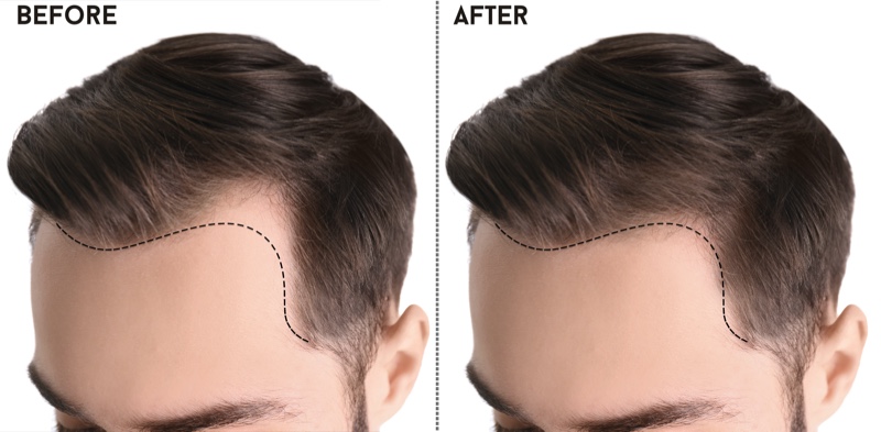 Man Hairline Before After