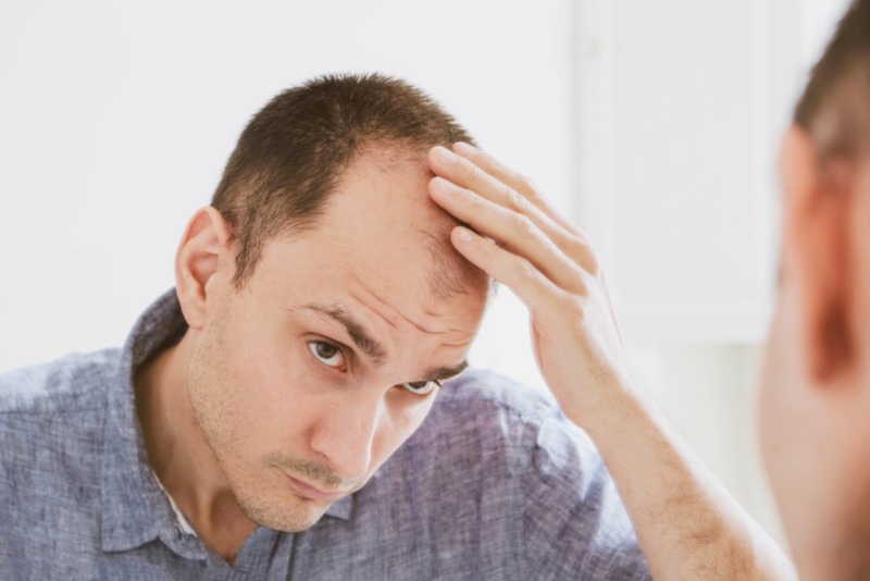 Man Hair Loss Severe Man Hair Loss Severe