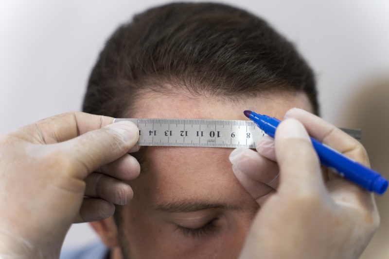 Hair Loss Follicular Unit Extraction » Male Hair Loss: On the Path to Becoming History Hair Loss Follicular Unit Extraction