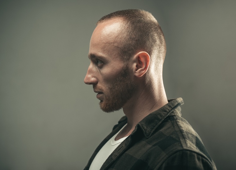 Hair Loss Modern Men