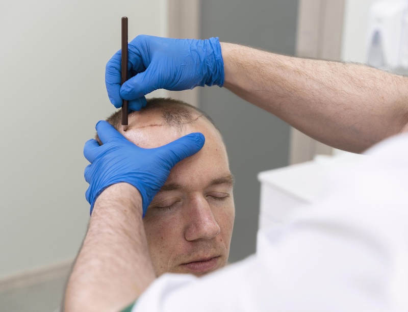 Man Hair Loss Procedure
